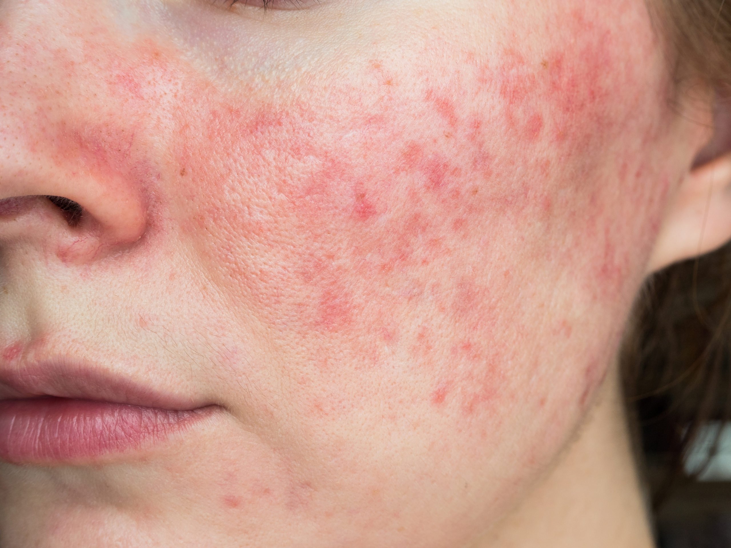 Are There Any New Treatments For Rosacea