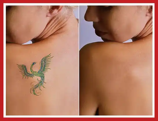 Before and After Image of Tattoo Removal | CMA Primary Care & Medspa in Windsor & Hartford, CT