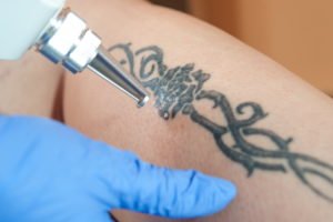 Is Tattoo Removal Safe | CMA PrimaryCare & MedSpa